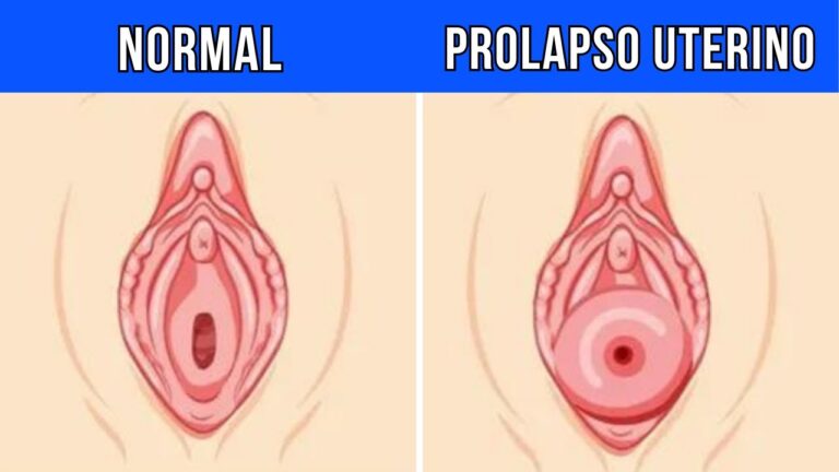Custo da Cirurgia de Prolapso Uterino: O Que Você Precisa Saber