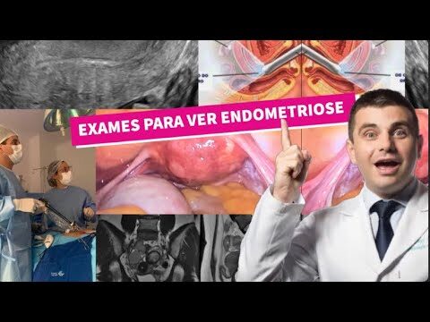 Exames para Diagnóstico da Endometriose