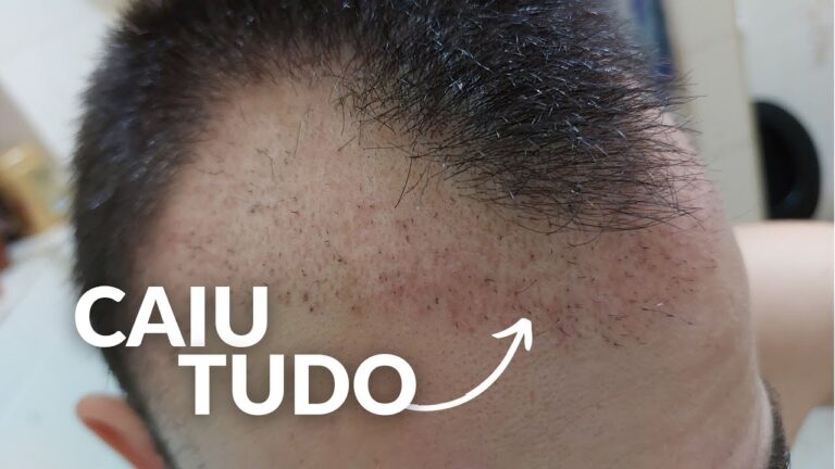 Resultados do Transplante Capilar: O Que Esperar 1 Mês Após o Procedimento