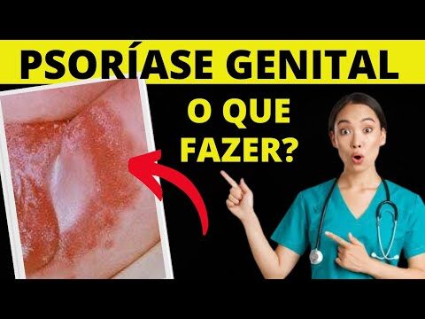 Psoríase na Virilha: Causas, Sintomas e Tratamentos Eficazes