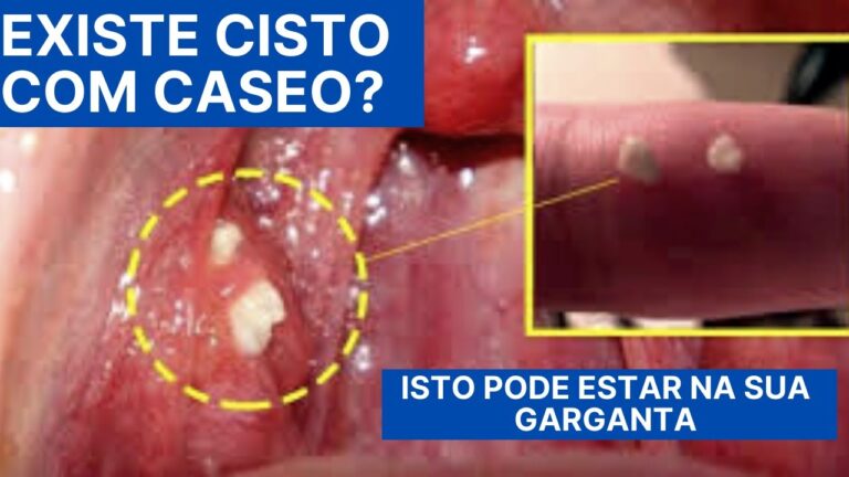 Entendendo a Amigdalite Crônica Caseosa: Causas e Tratamentos
