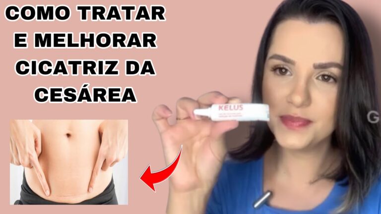 Cicatriz Ces&aacute;rea Alta: Cuidados e Est&eacute;tica P&oacute;s-Parto