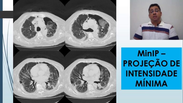 Tomografia na Avaliação da Fibrose Pulmonar