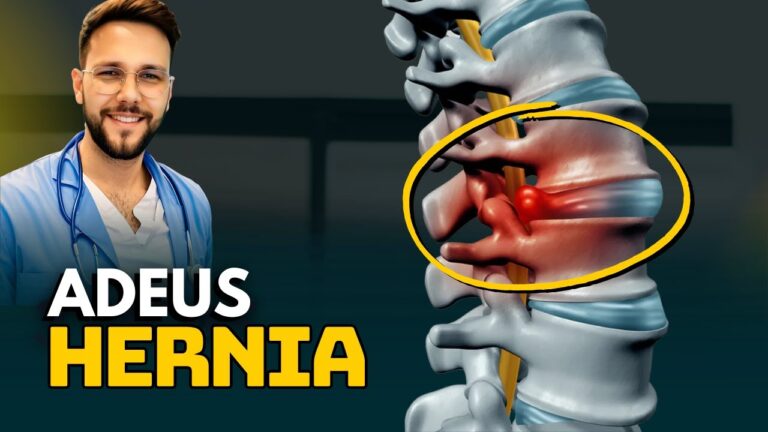 Tratamento Eficaz para Hérnia de Disco e Nervos Ciáticos