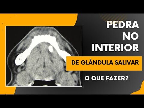 Entendendo a Pedra na Glândula Salivar: Causas e Tratamentos