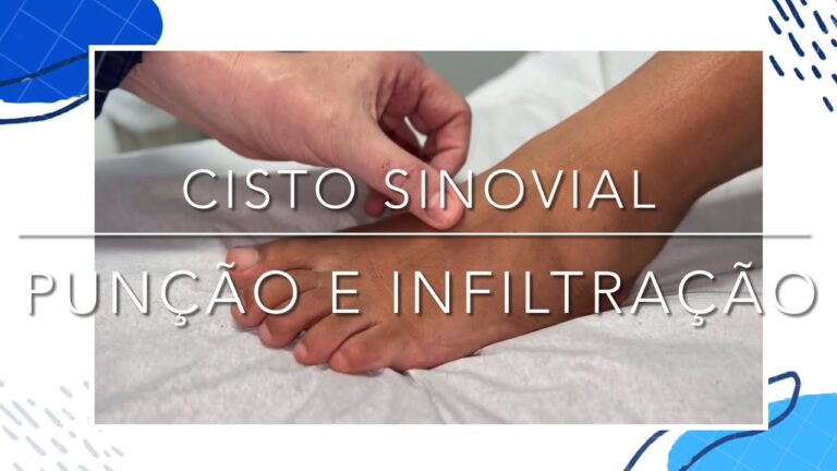 Cirurgia para Cisto Sinovial no Pé: Opções e Recuperação