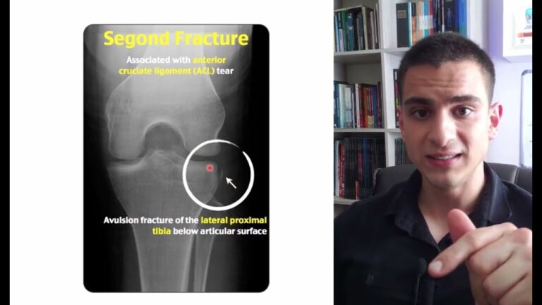 Raio X de Joelho: Diagnóstico de Ligamento Rompido