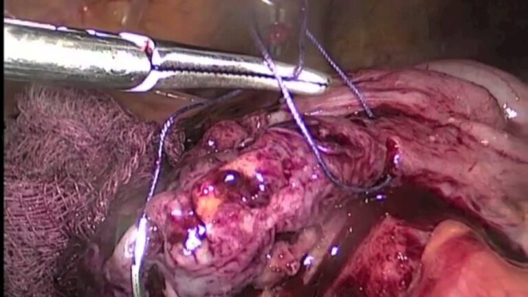 Cuidados e Tratamento da Cicatriz de Apendicectomia