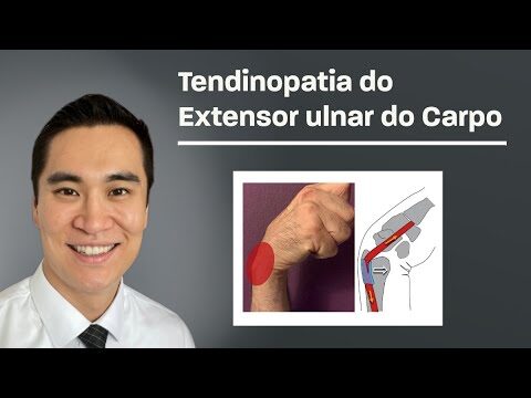 Tendão do Punho: Causas, Sintomas e Tratamentos Eficazes