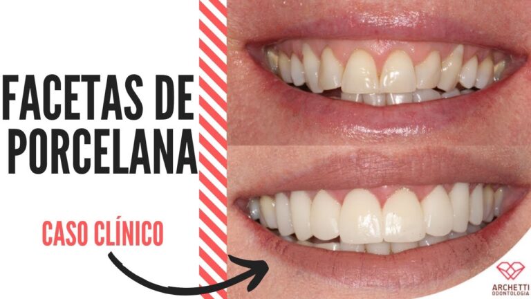 Transformação do Sorriso: Antes e Depois dos Dentes de Porcelana