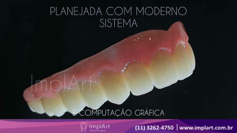 Fotos de Prótese Dentária Provisória: Guia Completo