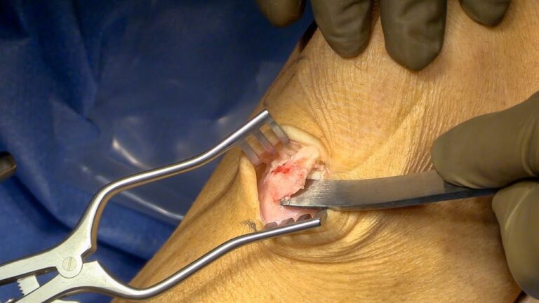 Preços da Cirurgia para Osgood-Schlatter