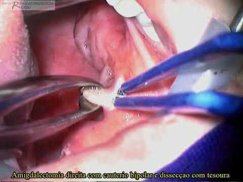 Adenoamigdalectomia: Benefícios e Cuidados Pós-Operatórios