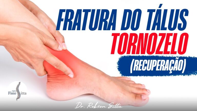 Tratamento Eficaz da Fratura de Astrágalo