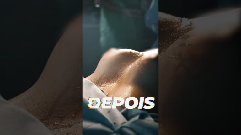 Transformações da Mamoplastia Redutora: Antes e Depois