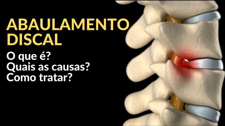 Entendendo o Abaulamento Discal: Causas e Tratamentos