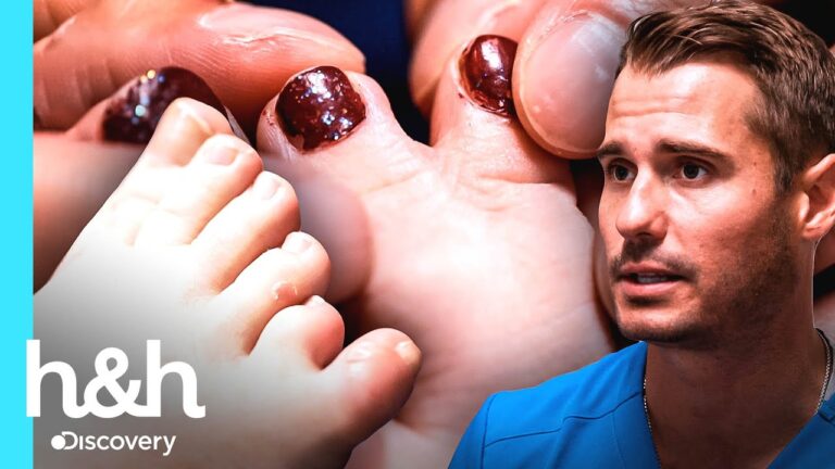 Cirurgia nos Dedos dos Pés: Tudo o que Você Precisa Saber