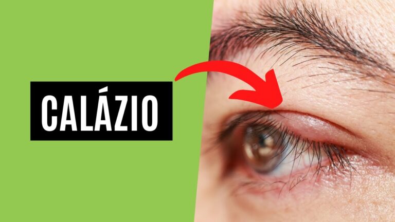 Entendendo o Calázio: Causas, Sintomas e Tratamentos