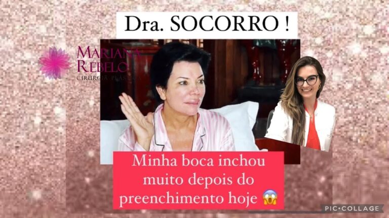 Tempo de Recuperação: Quanto Demora para Desinchar a Boca Após Preenchimento?