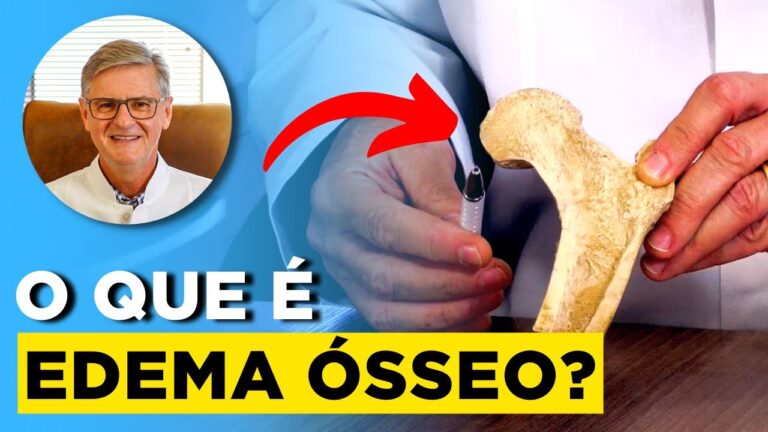 Entendendo o Edema Ósseo no Pé: Causas e Tratamentos