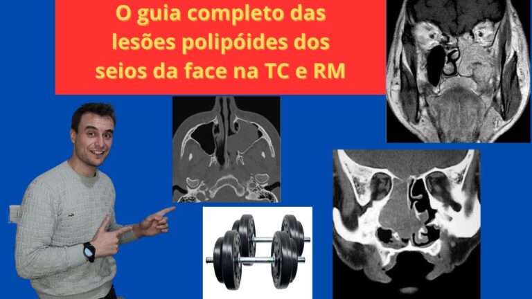 Tomografia Nasal: Avanços no Diagnóstico de Polipos