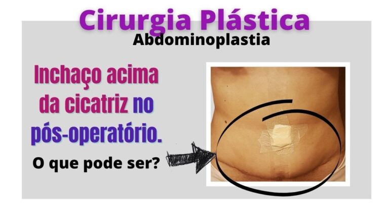 Complicações do Umbigo na Abdominoplastia