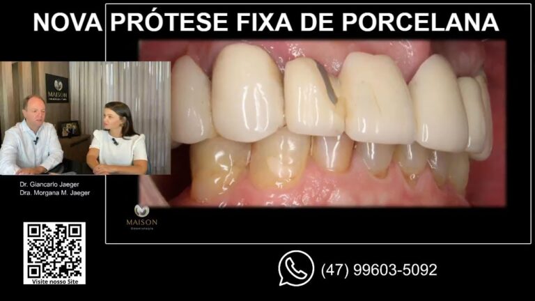 Vantagens da Ponte Fixa de Porcelana na Odontologia