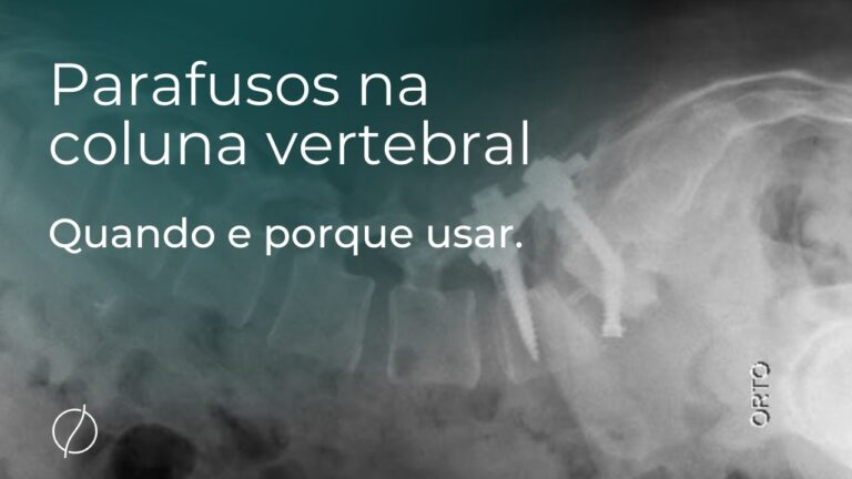 Recuperação Eficiente Após Cirurgia de Coluna Lombar com Parafusos