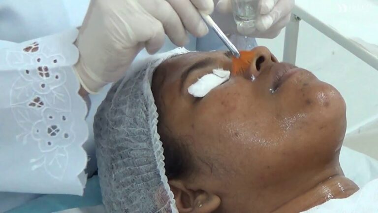 Entendendo o Processo do Peeling Qu&iacute;mico
