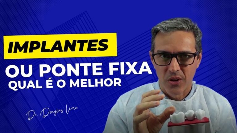 Ponte Fixa sobre Implantes: Solução Eficiente para Reabilitação Oral