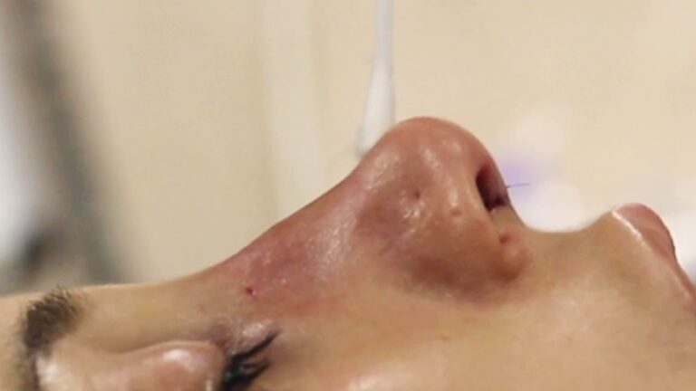 Resultados da Rinosseptoplastia: Antes e Depois