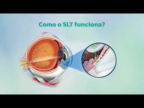 Preço da Cirurgia de Glaucoma a Laser: O Que Você Precisa Saber