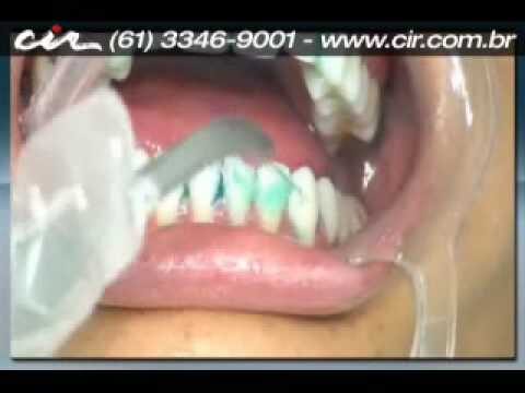 Significado da Profilaxia Dental: Entenda a Import&acirc;ncia para Sua Sa&uacute;de Bucal