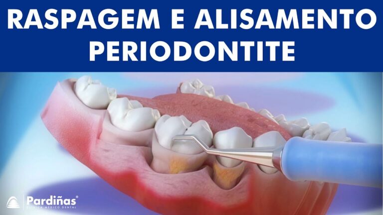 Tratamento Periodontal: Guia Passo a Passo