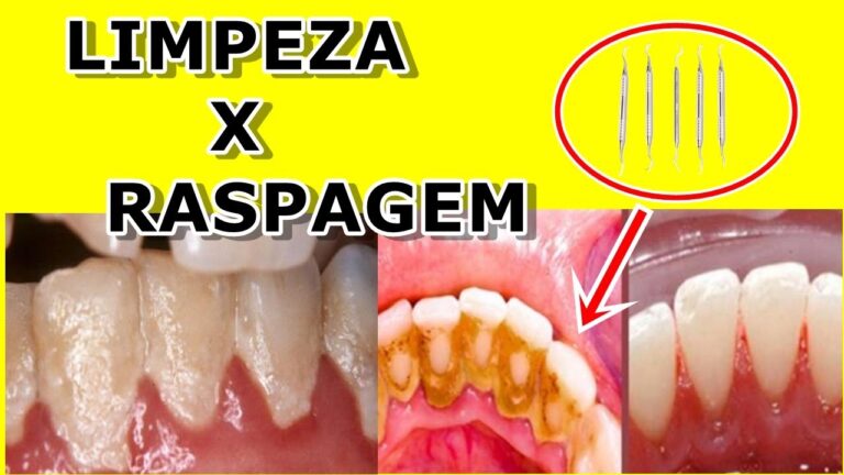 Raspagem Dental: Clareamento Eficaz dos Dentes