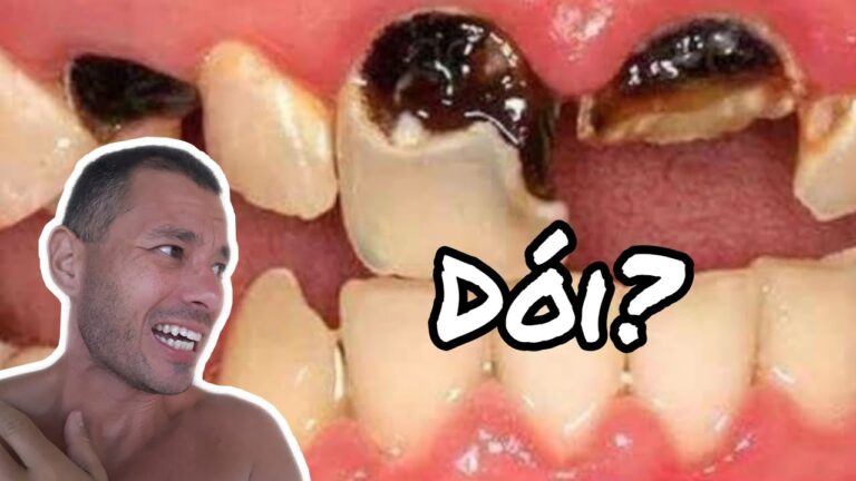 Restaura&ccedil;&atilde;o Eficaz para Dentes D&oacute;i