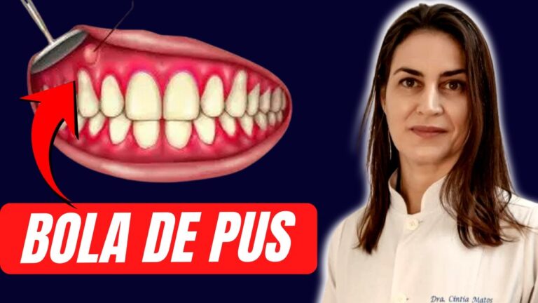 Bolinha com Pus na Gengiva: Causas e Tratamentos