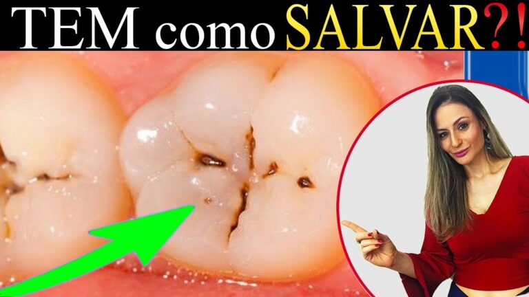 Entendendo a Cárie Marrom: Causas, Prevenção e Tratamento