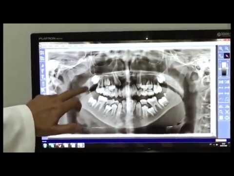 Importância do Raio X em Dentes de Leite