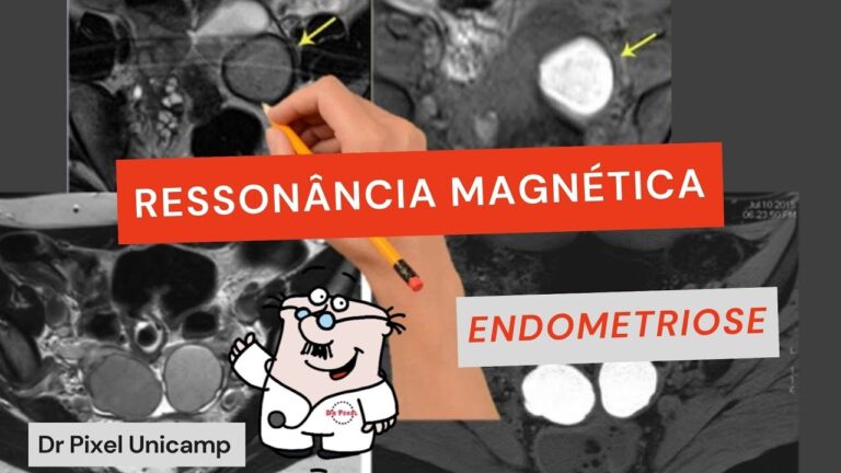 Ressonância Pélvica: Diagnóstico Eficaz da Endometriose
