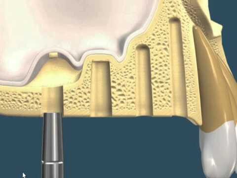 Tratamento Eficaz da Extensão Alveolar Maxilar