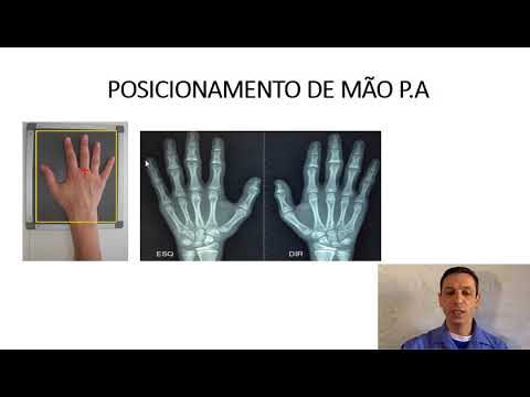 Análise Radiográfica dos Ossos da Mão