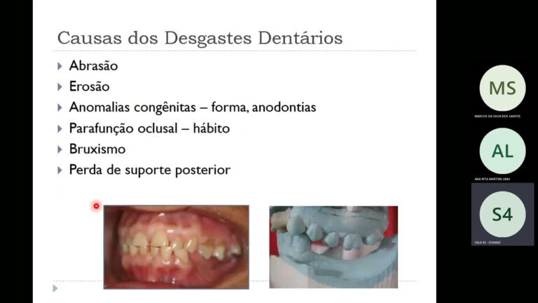 Pr&oacute;tese Parcial Remov&iacute;vel Superior Provis&oacute;ria: Vantagens e Cuidados