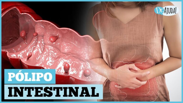 O Que é Pólipo: Entenda suas Causas e Tratamentos
