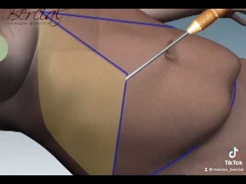 Abdominoplastia Ancorada: Benefícios e Resultados