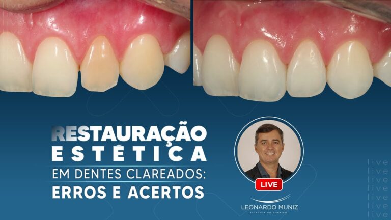 Restauração Estética de Dentes: Transformando Sorrisos com Harmonia