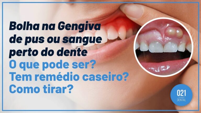 Bolha na Gengiva de Crian&ccedil;a: Causas e Tratamentos