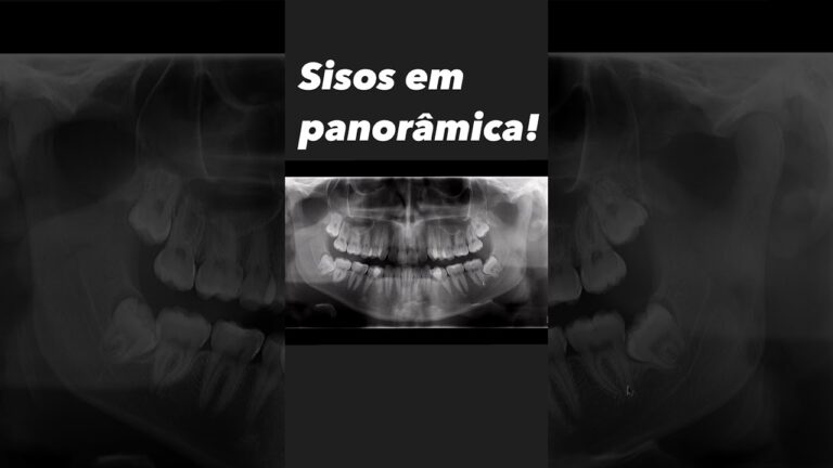 Radiografia Panor&acirc;mica para Siso: Import&acirc;ncia e Benef&iacute;cios