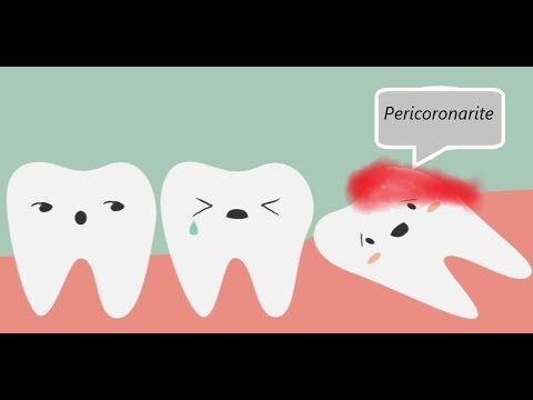 Cid: Entendendo a Infecção Dentária e Seus Tratamentos