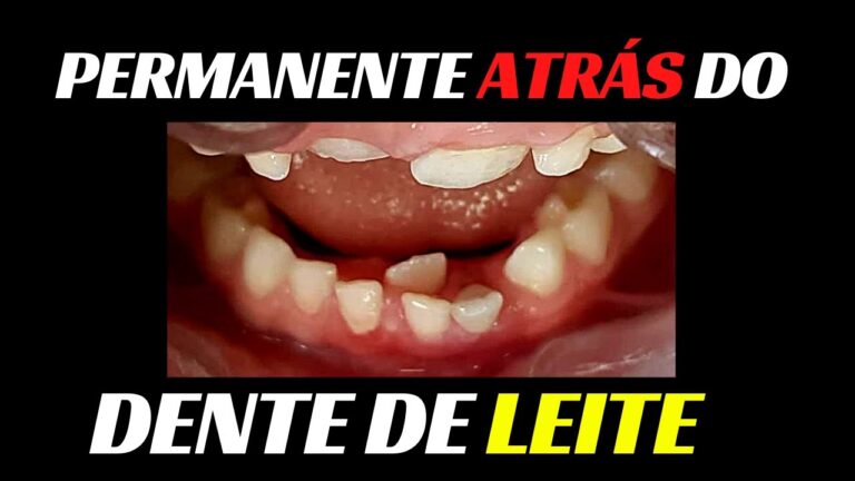 Dente Encavalado Infantil: Causas e Tratamentos Eficazes
